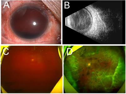 Case Report: Hereditary transthyretin (ATTRv) amyloidosis: The p.G103R mutation of the transthyretin gene in a Han Chinese family is associated with vitreous hemorrhage